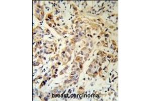 KRT13 Antibody (N-term) (R) IHC analysis in formalin fixed and paraffin embedded human breast carcinoma followed by peroxidase conjugation of the secondary antibody and DAB staining. (Cytokeratin 13 antibody  (N-Term))