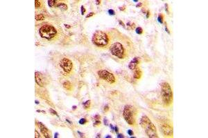 Immunohistochemical analysis of JUND (pS255) staining in human lung cancer formalin fixed paraffin embedded tissue section. (JunD antibody  (C-Term, pSer255))