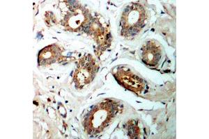 Immunohistochemistry of paraffin-embedded human breast carcinoma using Phospho-YWHAZ-S58 antibody (ABIN2987575).