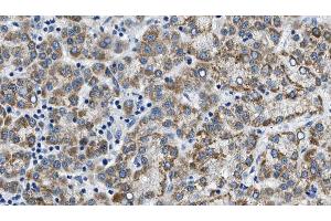 ABIN6274605 at 1/100 staining Human liver cancer tissue by IHC-P.