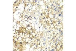 Immunohistochemistry of paraffin-embedded human kidney cancer using SDC1 antibody at dilution of 1:200 (400x lens). (Syndecan 1 antibody)
