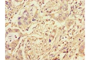 Immunohistochemistry of paraffin-embedded human pancreatic cancer using ABIN7164173 at dilution of 1:100