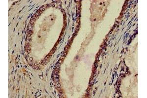 Immunohistochemistry of paraffin-embedded human prostate cancer using ABIN7162439 at dilution of 1:100 (P2RX1 antibody  (AA 54-175))