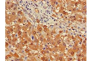 Immunohistochemistry of paraffin-embedded human liver cancer using ABIN7163274 at dilution of 1:100 (Phosphoglucomutase 1 antibody  (AA 1-562))
