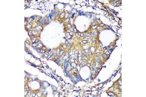 Immunohistochemistry of paraffin-embedded Human colon carcinoma using B Rabbit pAb (ABIN7265675) at dilution of 1:100 (40x lens). (ACTR1B antibody  (AA 1-105))