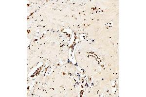Immunohistochemistry analysis of paraffin embedded human breast cancer using C23 (ABIN7074906) at dilution of 1: 550 (Nucleolin antibody)