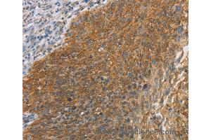 Immunohistochemistry of Human breast cancer using MAPK6 Polyclonal Antibody at dilution of 1:40 (MAPK6 antibody)