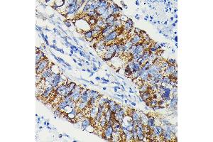 Immunohistochemistry of paraffin-embedded human colon carcinoma using J Rabbit mAb (ABIN7268036) at dilution of 1:100 (40x lens). (JAK1 antibody)