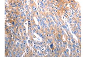 The image on the left is immunohistochemistry of paraffin-embedded Human ovarian cancer tissue using ABIN7192492(SLC44A1 Antibody) at dilution 1/25, on the right is treated with synthetic peptide.