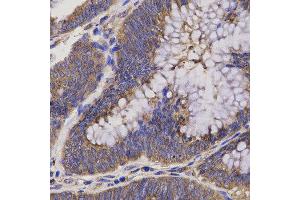 Immunohistochemistry of paraffin-embedded human rectum cancer using EPHX2 antibody at dilution of 1:200 (x40 lens)