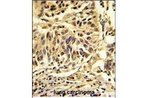 Formalin-fixed and paraffin-embedded human lung carcinoma reacted with CEBPB Antibody (C-term), which was peroxidase-conjugated to the secondary antibody, followed by DAB staining. (CEBPB antibody  (C-Term))
