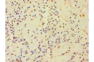 Immunohistochemistry of paraffin-embedded human breast cancer using ABIN7154834 at dilution of 1:100 (HAUS3 antibody  (AA 384-603))
