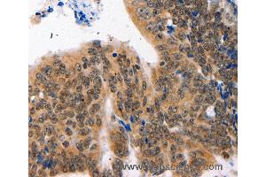 Immunohistochemistry of Human colon cancer using NAIF1 Polyclonal Antibody at dilution of 1:60 (NAIF1 antibody)