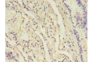 Immunohistochemistry of paraffin-embedded human lung tissue using ABIN7157832 at dilution of 1:100 (B3GNT5 antibody  (AA 65-344))