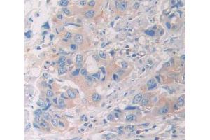 DAB staining on fromalin fixed paraffin- embedded breast cancer tissue) (UBE2S antibody  (AA 1-209))