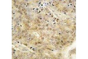IHC analysis of FFPE human prostate carcinoma tissue stained with EZH1 antibody (EZH1 antibody  (AA 393-422))