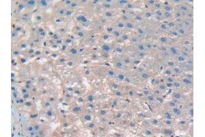 IHC-P analysis of Human Liver Cancer Tissue, with DAB staining. (CD276 antibody  (AA 47-219))