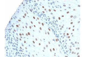 Formalin-fixed, paraffin-embedded human Urothelial Carcinoma stained with p21 Rabbit Recombinant Monoclonal Antibody (CIP1/2275R). (Recombinant p21 antibody)