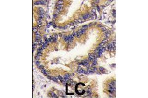 Formalin-fixed and paraffin-embedded human lung carcinoma tissue reacted with URM1 polyclonal antibody  , which was peroxidase-conjugated to the secondary antibody, followed by DAB staining. (Urm1 antibody  (N-Term))