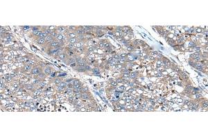 Immunohistochemistry of paraffin-embedded Human liver cancer tissue using XIRP1 Polyclonal Antibody at dilution of 1:90(x200) (XIRP1 antibody)
