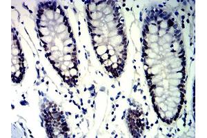 Immunohistochemical analysis of paraffin-embedded colon tissues using MSH6 mouse mAb with DAB staining.