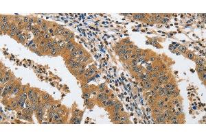 Immunohistochemistry of paraffin-embedded Human gastric cancer tissue using PIK3R3 Polyclonal Antibody at dilution 1:45 (PIK3R3 antibody)