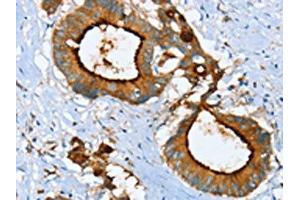 The image on the left is immunohistochemistry of paraffin-embedded Human colon cancer tissue using ABIN7130083(LGALS3BP Antibody) at dilution 1/25, on the right is treated with fusion protein. (LGALS3BP antibody)