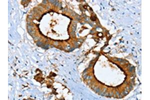 The image on the left is immunohistochemistry of paraffin-embedded Human colon cancer tissue using ABIN7130083(LGALS3BP Antibody) at dilution 1/25, on the right is treated with fusion protein.