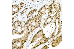 Immunohistochemistry of paraffin-embedded human colon carcinoma using METTL16 Rabbit pAb (ABIN7268501) at dilution of 1:100 (40x lens). (METTL16 antibody  (AA 263-562))