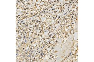 Immunohistochemistry of paraffin-embedded human kidney cancer using PRDX4 antibody at dilution of 1:200 (x400 lens) (Peroxiredoxin 4 antibody)