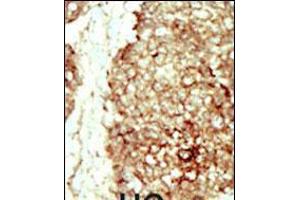 Formalin-fixed and paraffin-embedded human cancer tissue reacted with the primary antibody, which was peroxidase-conjugated to the secondary antibody, followed by DAB staining. (FGFR2 antibody  (C-Term))