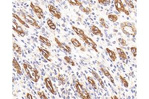 Immunohistochemistry analysis of paraffin-embedded human stomach cancer using CK-7 Monoclonal Antibody at dilution of 1:300. (Cytokeratin 7 antibody)