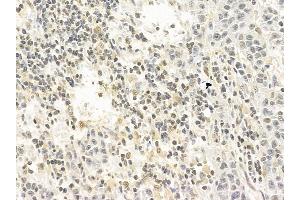 STAT1 Mouse Monoclonal Antibody at 1/100 staining human gastric cancer by IHC-P.