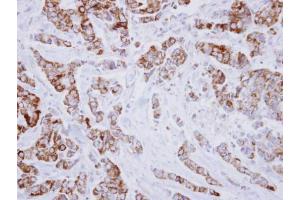 IHC-P Image Immunohistochemical analysis of paraffin-embedded human breast cancer, using IVD, antibody at 1:250 dilution.