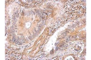 IHC-P Image DAP5 antibody [C2C3], C-term detects EIF4G2 protein at cytosol on human gastric cancer by immunohistochemical analysis. (EIF4G2 antibody  (C-Term))