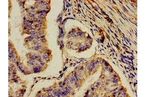 Immunohistochemistry of paraffin-embedded human endometrial cancer using ABIN7159328 at dilution of 1:100 (AOC3 antibody  (AA 27-259))