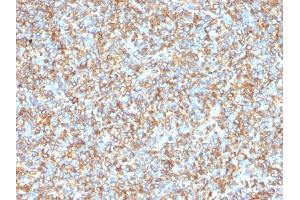 Formalin-fixed, paraffin-embedded human Ewing's Sarcoma stained with Vimentin Mouse Monoclonal Antibody (VM1170).