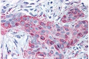 Anti-MMP13 antibody  ABIN1049066 IHC staining of human breast carcinoma.