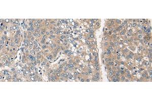 Immunohistochemistry of paraffin-embedded Human liver cancer tissue using CLIC6 Polyclonal Antibody at dilution of 1:40(x200) (CLIC6 antibody)