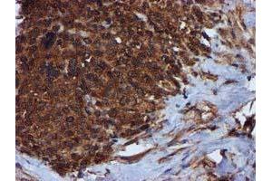 Immunohistochemical staining of paraffin-embedded Adenocarcinoma of Human breast tissue using anti-C1S mouse monoclonal antibody.