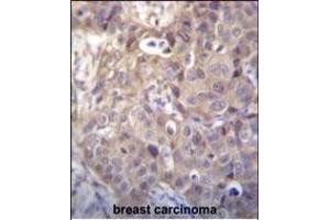 HIPK1 Antibody (C-term) (ABIN656398 and ABIN2845693) immunohistochemistry analysis in formalin fixed and paraffin embedded human breast carcinoma followed by peroxidase conjugation of the secondary antibody and DAB staining. (HIPK1 antibody  (C-Term))