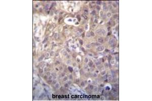 HIPK1 Antibody (C-term) (ABIN656398 and ABIN2845693) immunohistochemistry analysis in formalin fixed and paraffin embedded human breast carcinoma followed by peroxidase conjugation of the secondary antibody and DAB staining.