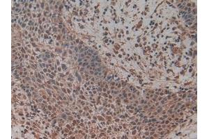 Detection of MCM5 in Human Skin cancer Tissue using Polyclonal Antibody to Minichromosome Maintenance Deficient 5 (MCM5) (Minichromosome Maintenance Deficient 5 (AA 331-537) antibody)