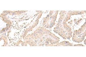 Immunohistochemistry of paraffin-embedded Human thyroid cancer tissue using ERGIC3 Polyclonal Antibody at dilution of 1:50(x200) (ERGIC3 antibody)