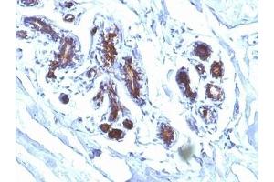 Formalin-fixed, paraffin-embedded human breast carcinoma stained with Lactadherin antibody (EDM45) (MFGE8 antibody)