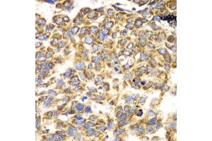 Immunohistochemistry of paraffin-embedded human esophageal cancer using TOMM20 antibody (ABIN5974102) at dilution of 1/100 (40x lens).