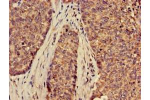 Immunohistochemistry of paraffin-embedded human ovarian cancer using ABIN7170127 at dilution of 1:100 (SLC2A9 antibody  (AA 473-511))