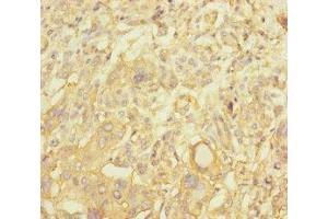 Immunohistochemistry of paraffin-embedded human pancreatic cancer using ABIN7161254 at dilution of 1:100