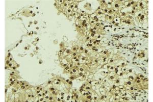 ABIN6267183 at 1/100 staining Human breast cancer tissue by IHC-P. (SQSTM1 antibody  (pSer349))