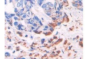 Detection of ADRP in Human Breast cancer Tissue using Polyclonal Antibody to Adipose Differentiation Related Protein (ADRP) (ADRP antibody  (AA 245-433))